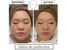 サロン ド パーフェクション(Salon de Perfection)/小顔リフト