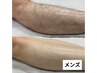 【メンズ光脱毛】VIO含む下半身全部脱毛44,000→22,000 初めての方へ！