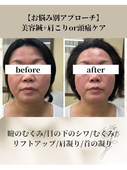 エムハナ鍼灸院(M.hana鍼灸院)/美容鍼+局所はりビフォアフ