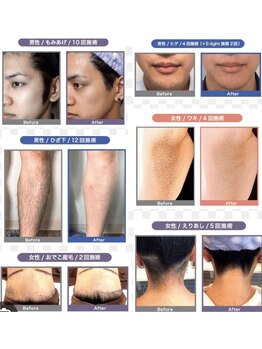 ヨロン(YORON)/美肌脱毛！自己処理から美肌へ！