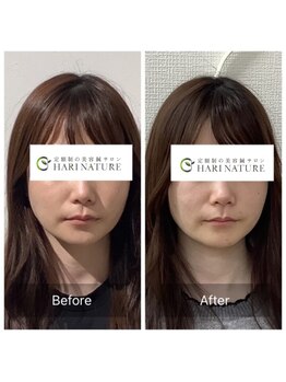 ハリナチュレ 西心斎橋店(HARINATURE)/Before After