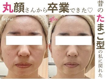 ソワンドビジュー(soin de bijew)/極上のインディバフェイシャル