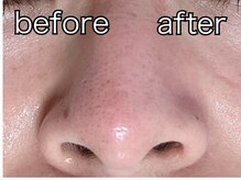 KMB 中崎町店/ハイドラフェイシャル/毛穴洗浄