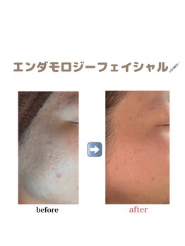 アイリス(AIRIS)/エンダモロジーフェイシャル