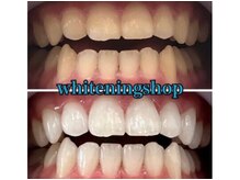 ホワイトニングショップ 鳥取店/ホワイトニングビフォーアフター