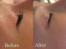 アティレ オオサカ(Attirer Osaka)/まぶたのたるみケア/くすみケア