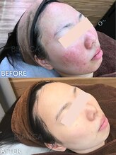 ビアンカ/赤みケア