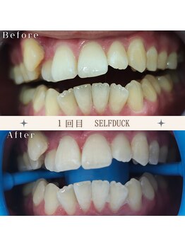 セルフダック 京都長岡京店/◇ホワイトニングの症例写真１０