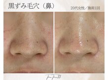 スリースリー 恵比寿(THREE THREE)/毛穴角栓・毛穴黒ずみ・毛穴開き