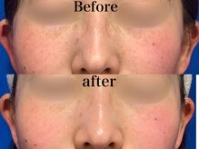 ヒール(heal)/症例