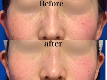 ヒール(heal)/症例