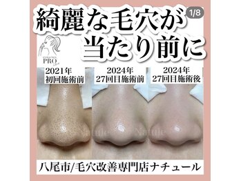 ナチュール(Natule)/毛穴改善コース