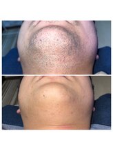 アルビーダ(RBDA)/ヒゲ脱毛　5回施術例