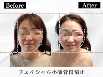 ポーベルポー(Peau Belle poe)/フェイシャル小顔矯正|５回目