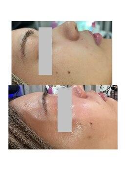 ラローゼ トウキョウ(LA ROSEE TOKYO)/毛穴レス×ツヤ×水光美肌革命！