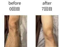 完全都度払い 明石メンズ脱毛/before/after 脚7回目