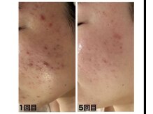 オプレア 栄店(OPREA)/REVIハーブピーリング♪