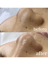 サロン ド ソワン(salon de soin)/毛穴エクストラクション