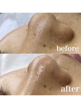 サロン ド ソワン(salon de soin)/毛穴エクストラクション