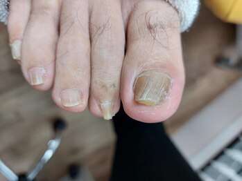 爪切り屋 足楽/肥厚爪・巻き爪【before】