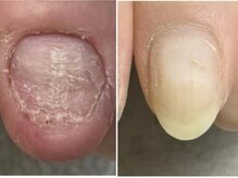 グレースレディ 大阪店/(深爪/長さだし/フィルイン)