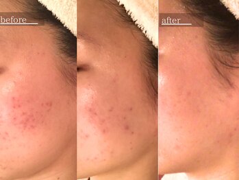 ホワイトカメリア(White Camellia)/【肌質改善ケア/ニキビケア】