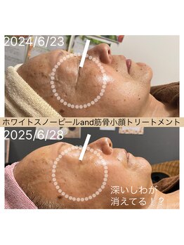 ココ 2号店(CoCo)/ホワイトスノーピール/しわ改善