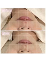 ペルラペティーユ(PERLA PETILLER)/小顔リフトアップ