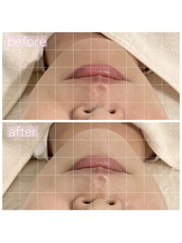 ペルラペティーユ(PERLA PETILLER)/小顔リフトアップ