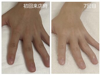 キレイテ 福岡天神店/手のくすみ・ごわつきでお悩み