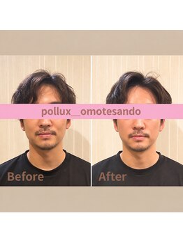 ポルクス鍼灸整骨院 表参道(Pollux鍼灸整骨院)/鍼灸　整体　美容鍼灸