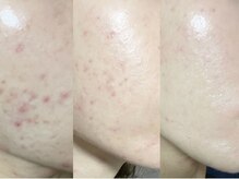 クオルーチェ(CuoLuce)/REVI陶肌トリートメント