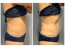 エイシスグロウ(asis glow.)/効果写真