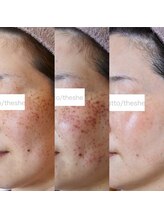 エトル(etole)/フォト美顔イオン導入＆トリプル