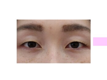 クロム アイプラス 狭山 入曽店(CHROM eye+)/腫れぼったく眠たげなまぶたに！