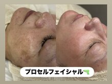 ラヴィ(Ravi)/プロセルフェイシャル