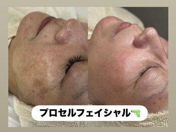 ラヴィ(Ravi)/プロセルフェイシャル