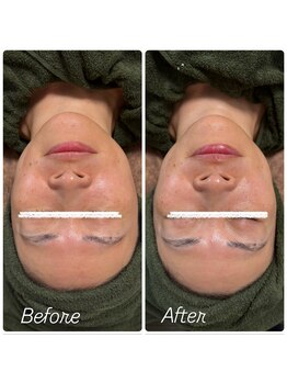 トータルビューティー雅/たった1回でこのツヤと小顔効果