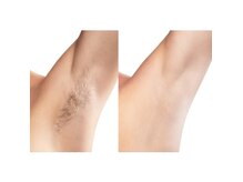 アネラ(ANELA)の雰囲気（早く終わる脱毛ならANELA]におまかせ！）