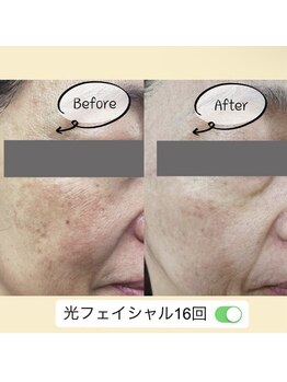 アイビークイーン(I.B.QUEEN)/赤ら顔、毛穴引き締め、もたつき