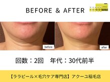 ア クーユ 稲毛店/レモンボトル/二重あご/小顔