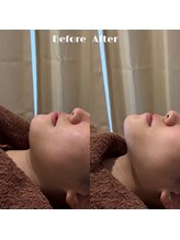 #美容革命ラボ 大阪南堀江店/レモンボトルで小顔へ/梅田難波