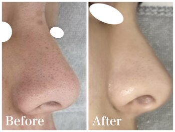 ノア 新宿(Noa)/ハーブピーリング+マシン 6回