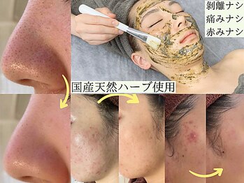 サロンドエルサ(Salon de ELSA)の写真/毛穴の黒ずみやザラつきをオーガニックケアで改善!国産ハーブピーリングでつるつる美肌へ◎