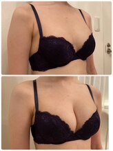 ラポッシュ(La poche)/バストアップ症例写真