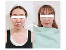 エピファニー 東京 銀座/ビフォーアフター（30代 A様）