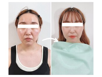 エピファニー 東京 銀座/ビフォーアフター(30代 A様)