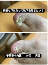 巻き爪じゅん 千葉駅前店/中央区の方の肥厚爪が劇的に改善