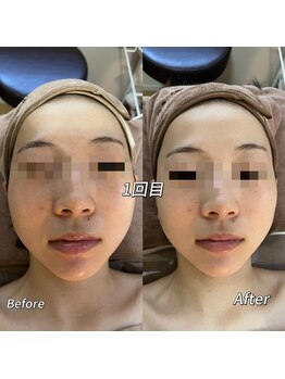 メイ 葛西(Mei)/1回で実感クリア素肌