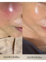 サロン ド エン(Salon de. en)/長年の赤み◇ハーブピーリング